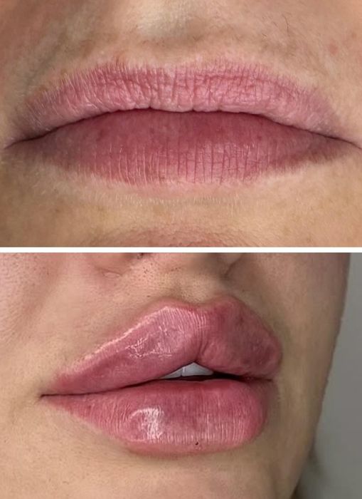 PROMOCJA powiększania ust 380zł , btx , Stymulatory