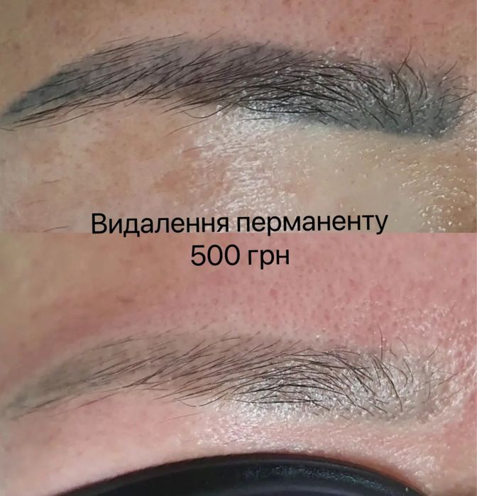 Видалення татуювання, перманенту