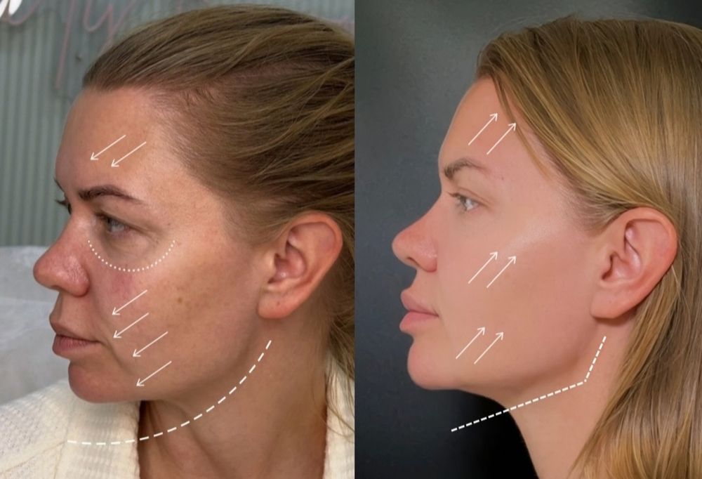 Promocja usta 1 ml Sosnowiec, lifting, wolumetria, BTX