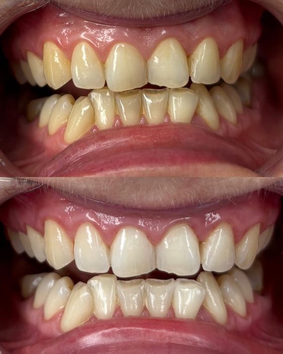 Kosmetyczne wybielanie zębów