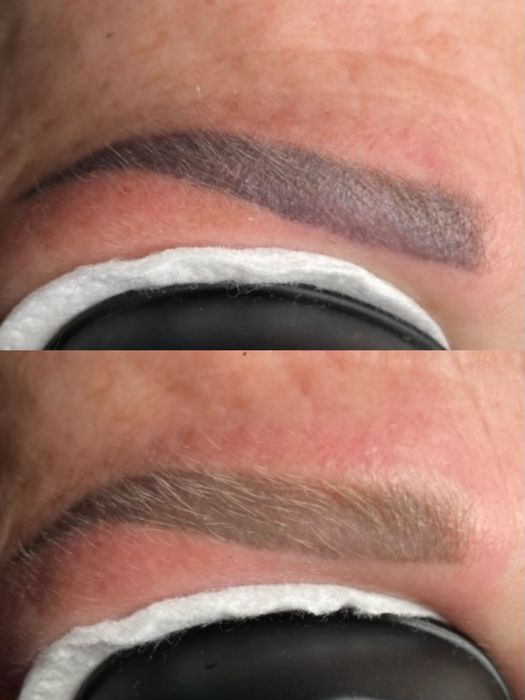 Видалення татуажа тату перманента лазером бровей стрелок губ ремувер