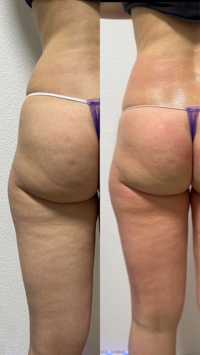 ТОП Массаж антицелюлітний,аппаратна корекція ,ліполазер,кавітація.