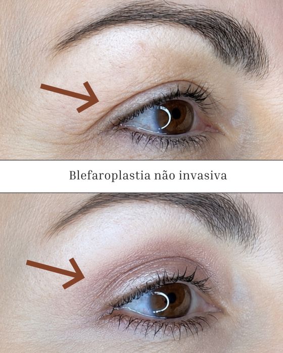Lifting de palpebras