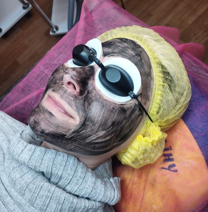 Карбоновий пілінг