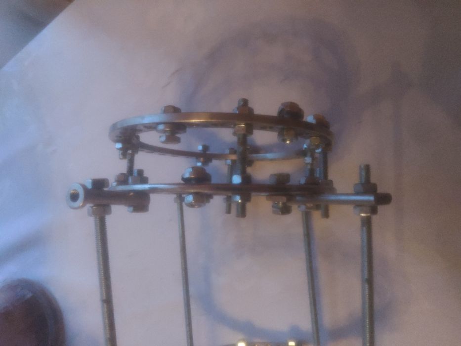 Апарат Ілізарова