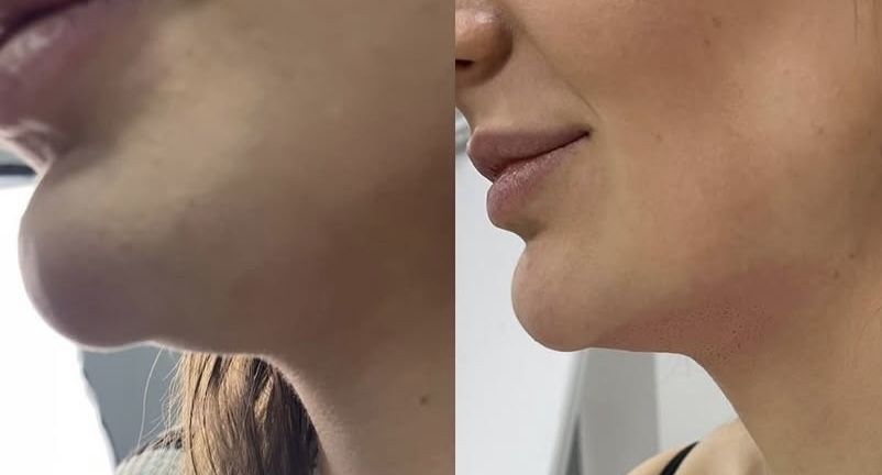 Безоперационная Блефаропластика