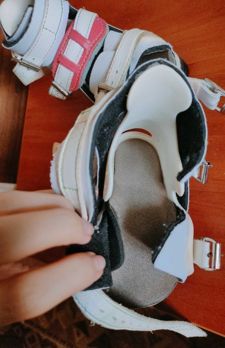 Брейсы для лечения косолапости