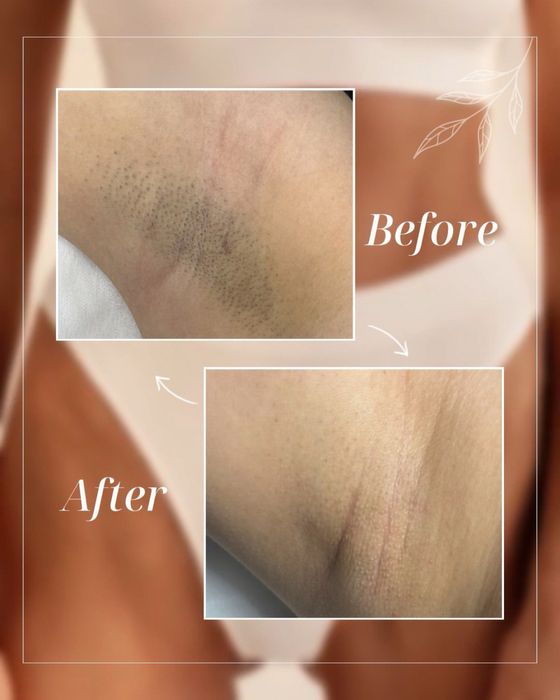 Лазерна епіляція в Запоріжжі — гладка шкіра надовго