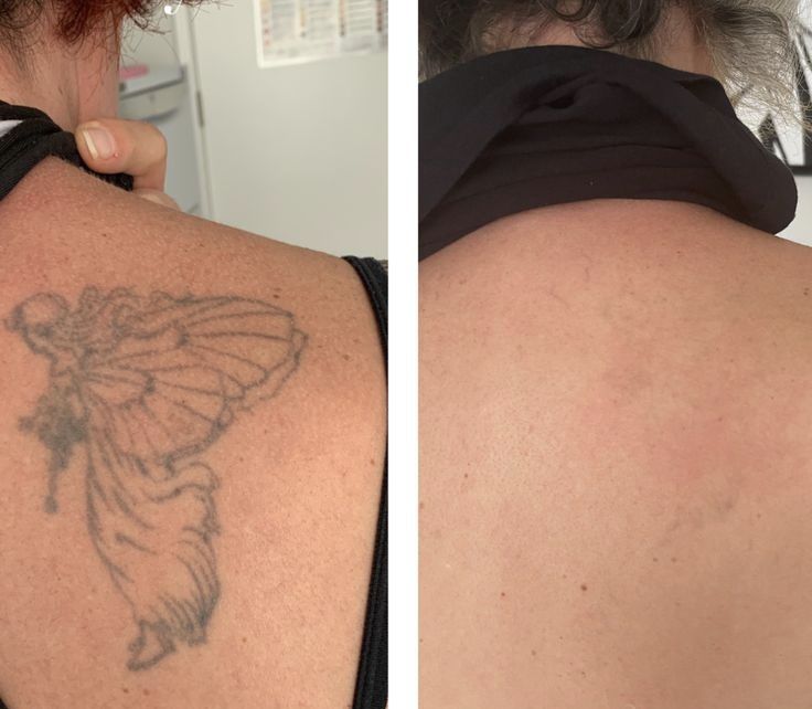 Професійний ,Діодний лазер пікосекундний   2в 1/ 808 1064 755nm