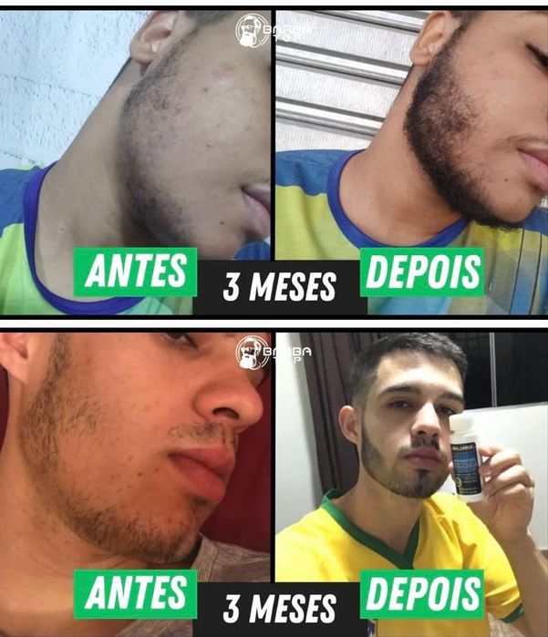 Minoxidil - original