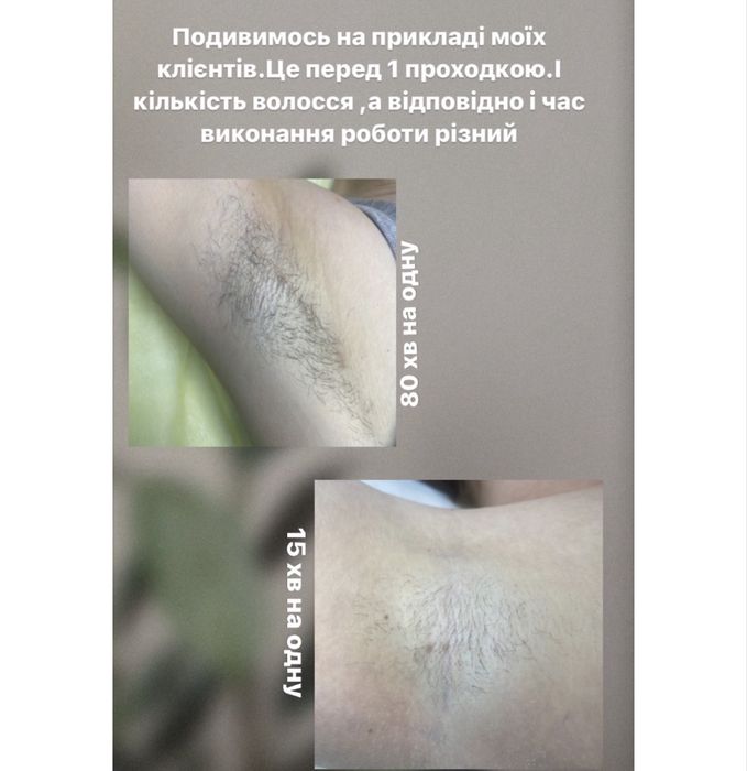 Електроепіляція, депіляція, шугаринг Вінниця