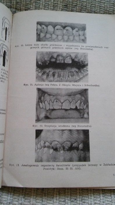 Całkowite korony stomatologiczne Wierzyński stomatologia korony