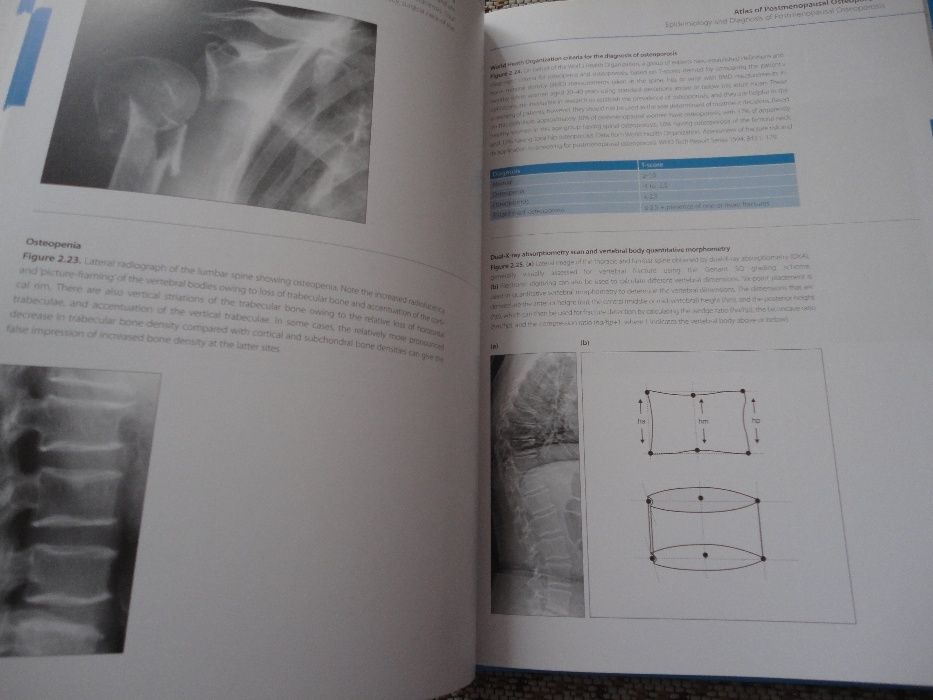 Livro Atlas of Postmenopausal Osteoporosis: Third Edition