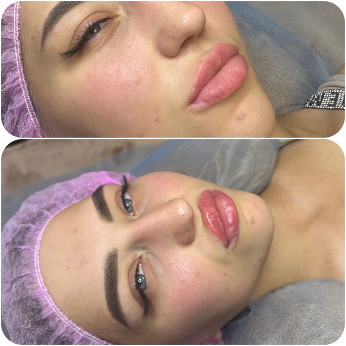 Увеличение губ и ботокс