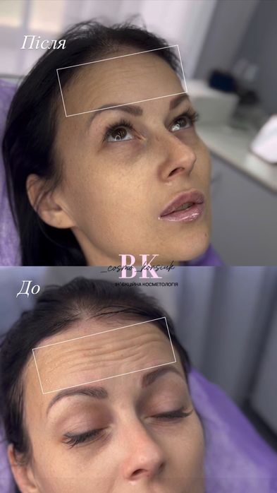 Косметолог|Ботокс|Контурна пластика губ.Центр міста