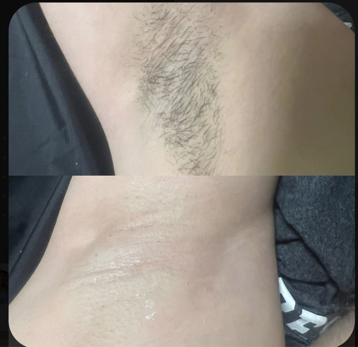 Шугаринг для підлітків та дорослих