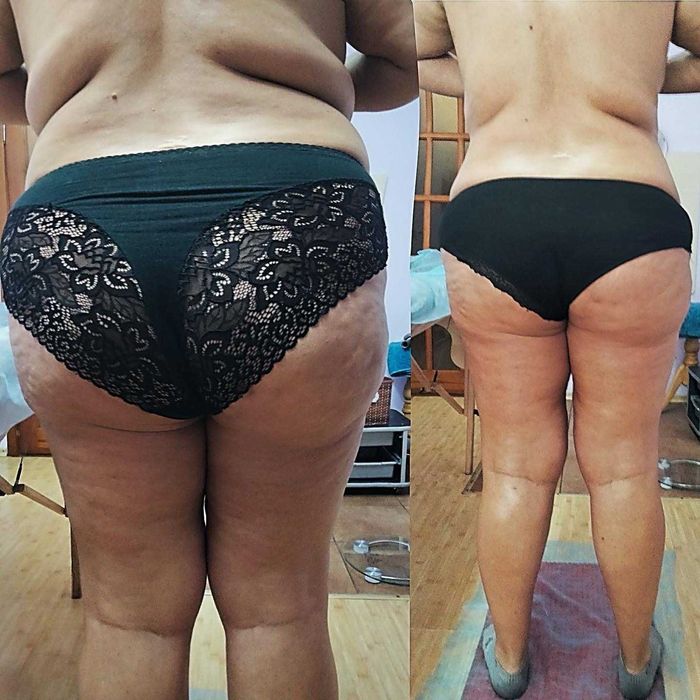 Антицеллюлитный массаж