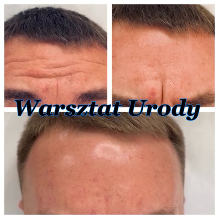 -50% POWIĘKSZANIE UST botox btx kwas hialuronowy NICI HACZYKOWE