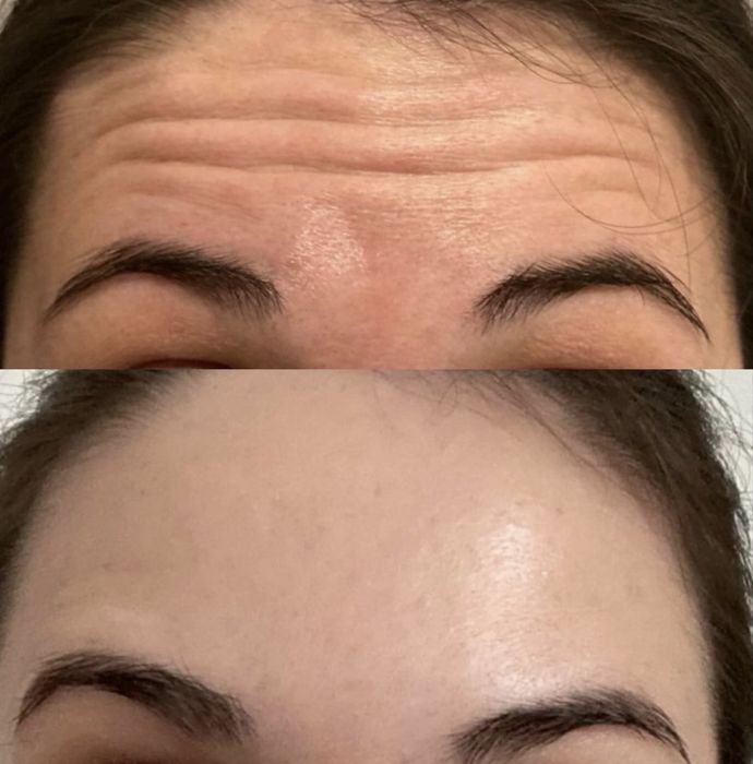 Ботокс! Ботулінотерапія