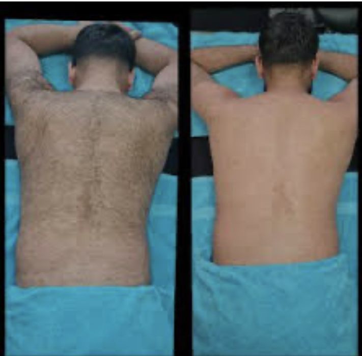 Depilaçao masculina : laser , cera e maquina de aparar .