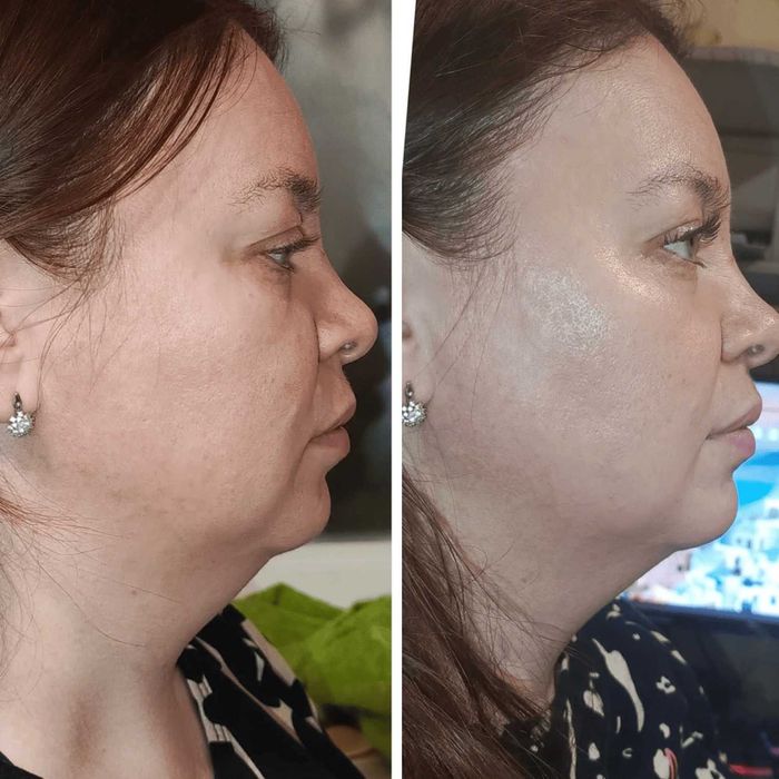 Мікрострумовий RF Lifting Масажер для обличчя Skin Lifting 7.0 Pink -