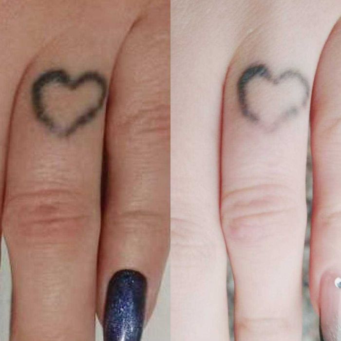 Видалення тату, татуювань і перманенту лазером. Київ, Лівий берег