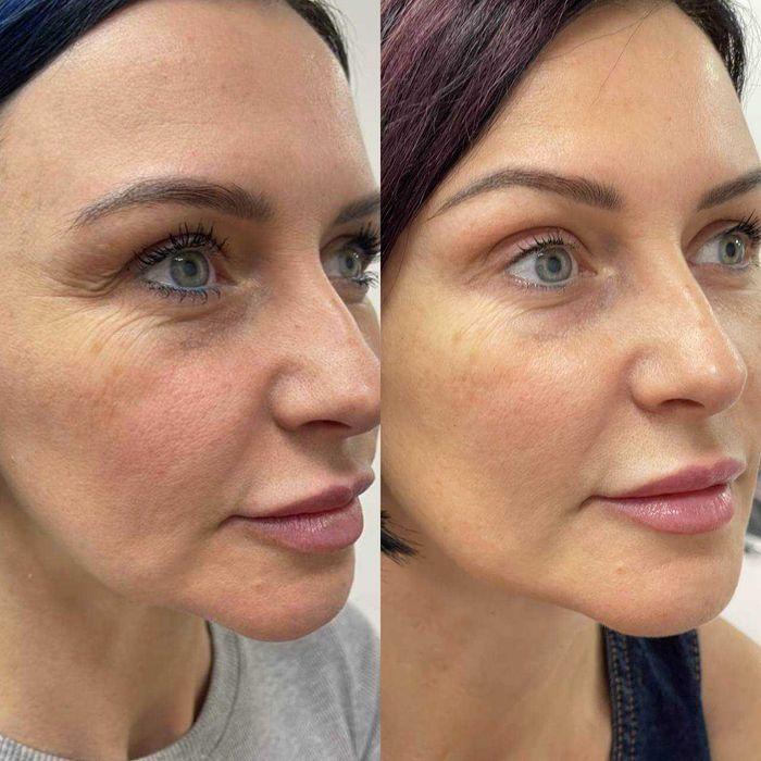 Osocze i Fibryna Kroplówki Detoks Cewnikowanie