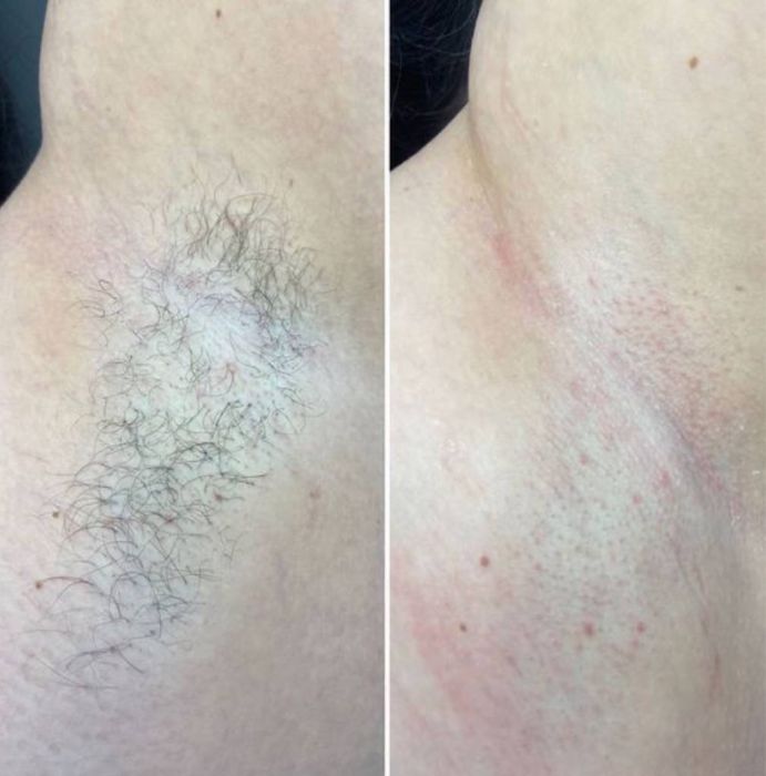 Воскова депіляція — гладенька шкіра надовго!