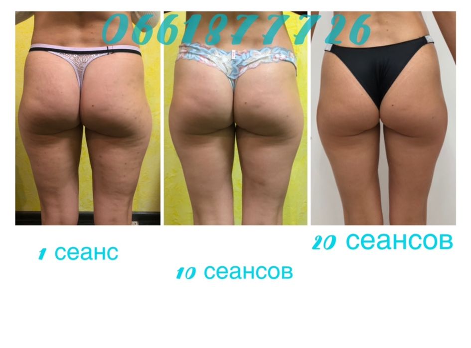 Антицеллюлитный массаж ЖК София