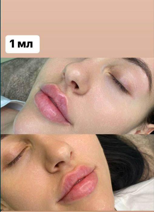 Губки ботокс гусинные лапки