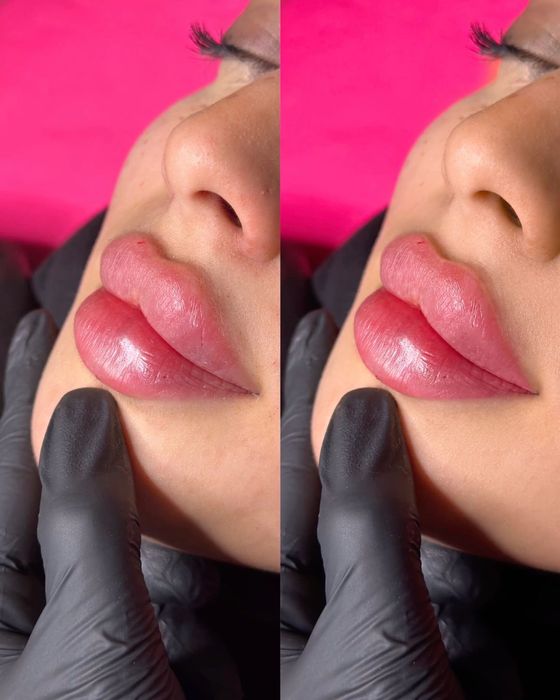 Контурна пластика, ін’єкції, ботокс