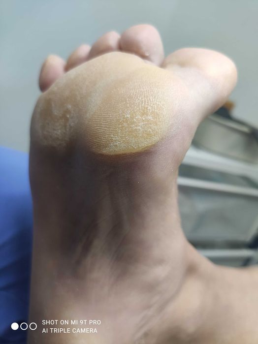 Tratamentos dos pés/Podologia