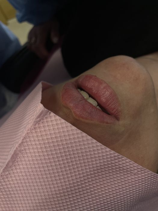 Контурна пластика, ін’єкції, ботокс