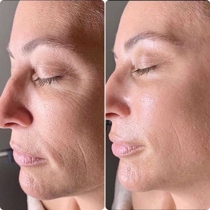 Osocze i Fibryna Kroplówki Detoks Cewnikowanie