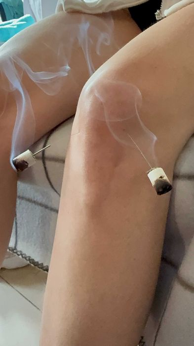 Akupunktura, Hirudoterapia, Bańki | Dojazd Gratis Wrocław | Naturopata