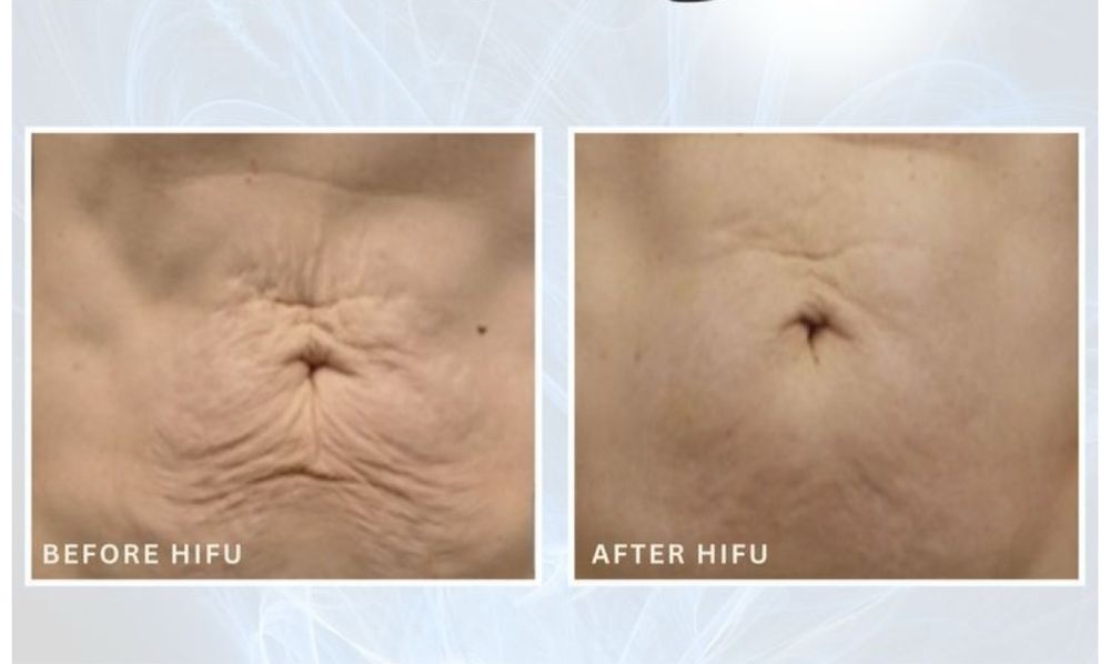 Tecnica de remocao de tatuagem, peeling e outros.