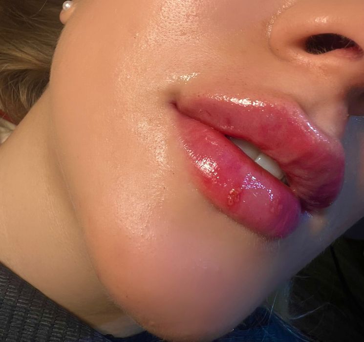 Збільшення губ ,Ботокс,Full Face,ліполітики