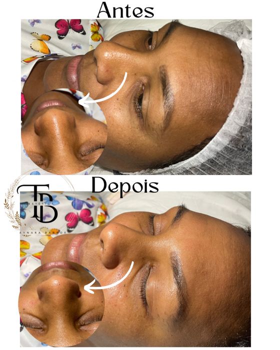 Limpeza de pele Profissional