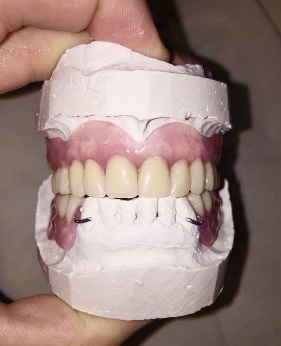 Съемное протезирование с выездом на дом