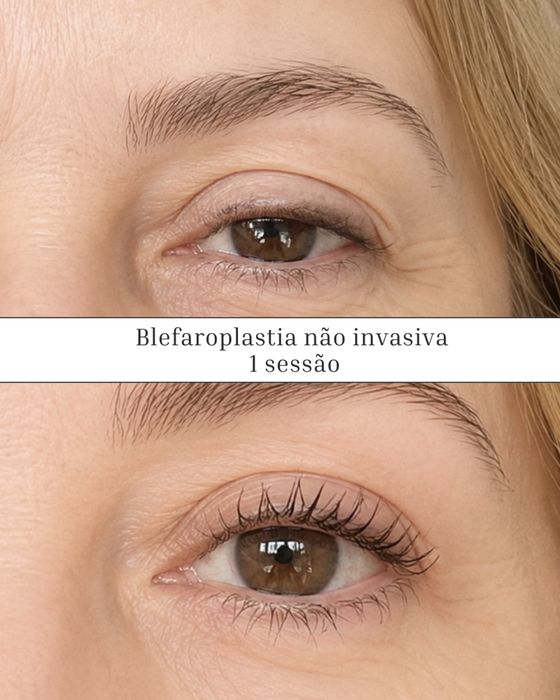 Lifting de palpebras