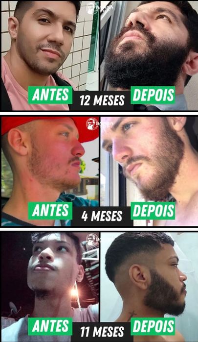 Minoxidil - original