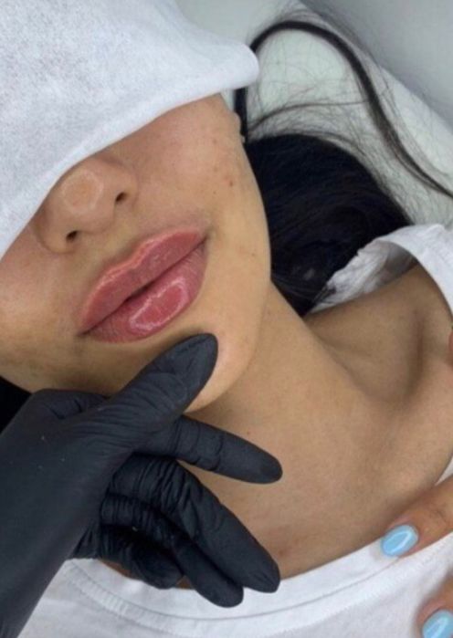 Акция!Индивидуальное обучение:ботулинотерапия,контурная пластика губ