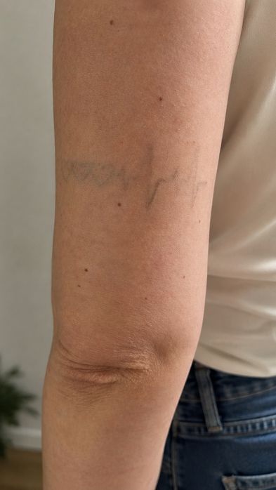 Modelos - Remoção de Tatuagem a Laser e Peeling de Hollywood