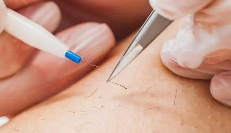 Depilação Elétrica/Eletrólise