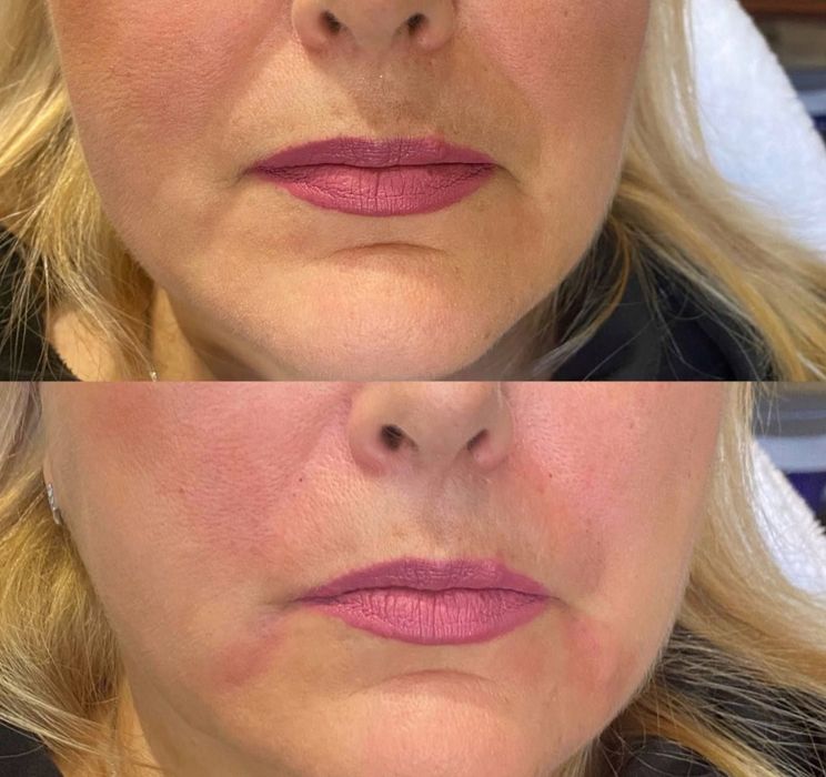 Губки ботокс гусинные лапки