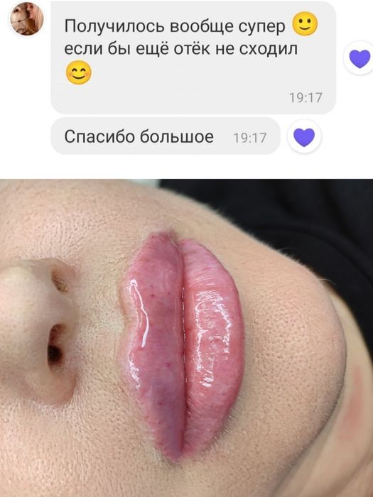 1500 грн губи контурна пластика.Ботокс.