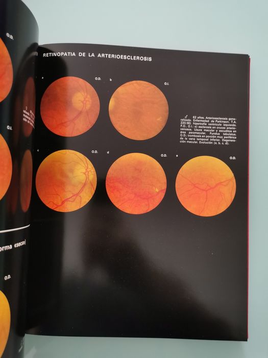 Atlas de Retinopatias vasculares