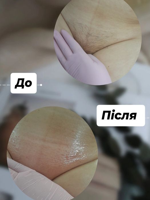 Воскова депіляція