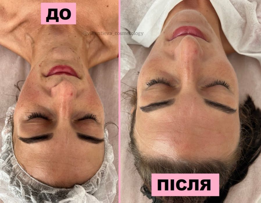 Косметолог Хмельницький | Мікронідлінг, Чистки, Догляд