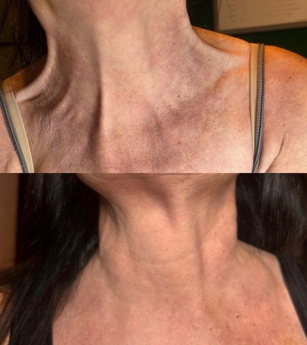 -50% BTX/ botoks/ botox/ powiększanie ust